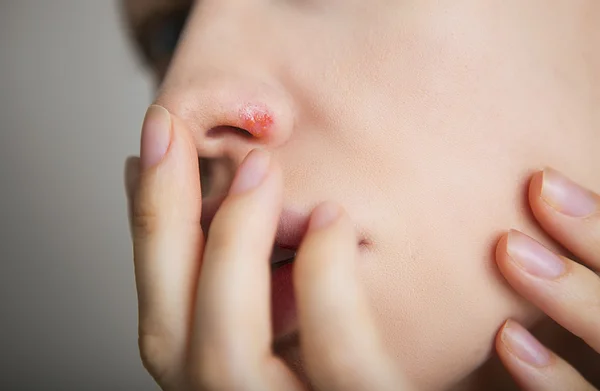 Herpes on the nose - young woman with herpes on her nose — Stock Photo, Image