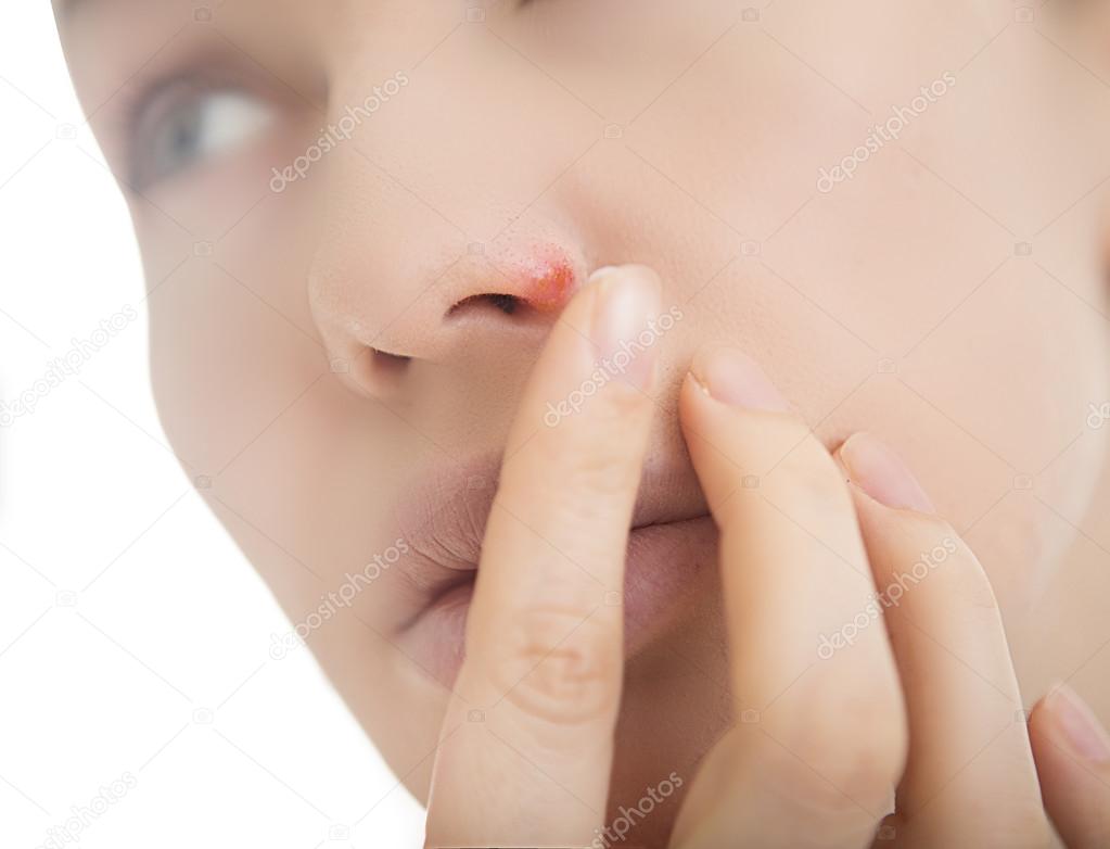 Herpes on the nose - young woman with herpes on her nose