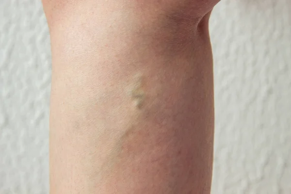 Φλεβίτιδα Γυναικείο Πόδι Κόμβος Κάτω Από Γόνατο Πρώτος Βαθμός Της — Φωτογραφία Αρχείου