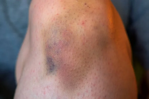 膝盖上的瘀伤 紧贴坐在沙发上手牵着受伤的腿和血肿的人的照片 — 图库照片