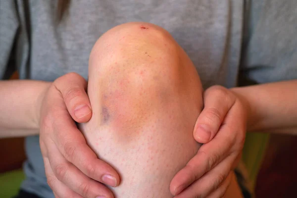 Поранення на коліні. Крупним планом зображення людини, що сидить на дивані і тримає в руках поранену ногу з гематомою . — стокове фото