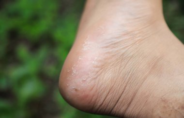 ayak hastalığının cilt üzerindeki etkisi sağlık hizmetleri içeriği olarak kullanılır