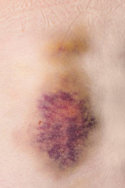 İnsan derisinde kanama olan büyük mor bir çürük.