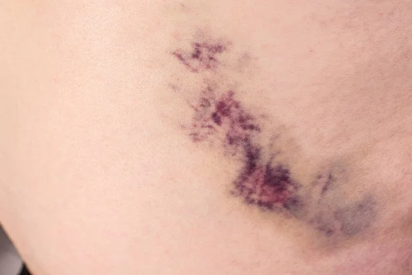 男の皮膚に出血して巨大な紫色の打撲傷 — ストック写真