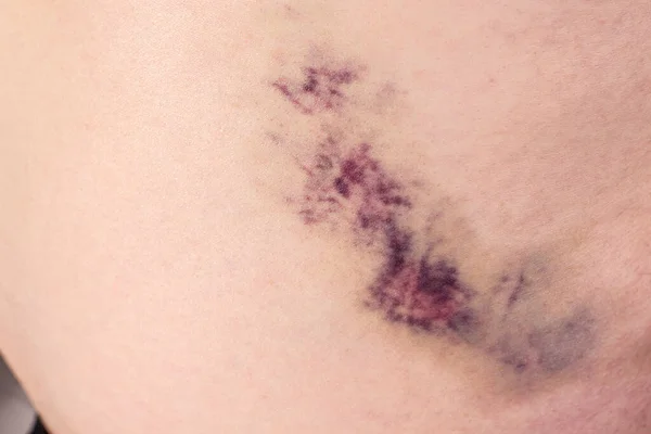 Enorme Hematoma Roxo Com Sangramento Pele Homem — Fotografia de Stock