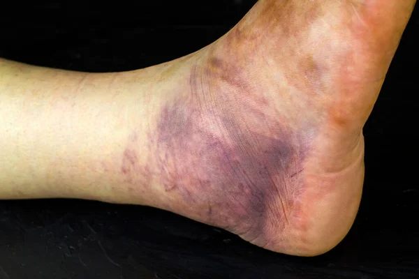 Broken Human Ankle Huge Purple Bruise Man Leg — Stock Photo, Image