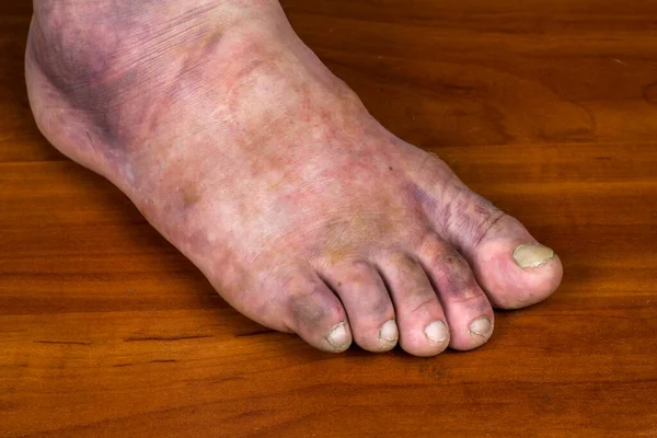Złamanie Ludzkiej Stopy Ogromny Fioletowy Siniak Nodze Mężczyzny — Zdjęcie stockowe