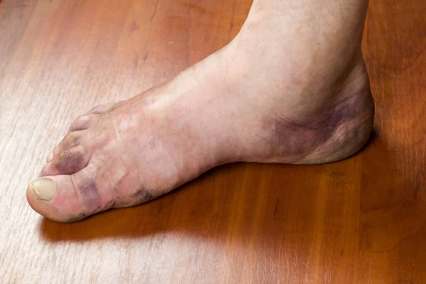 Swollen foot of a man's leg after a fracture. Purple bruise on human foot.