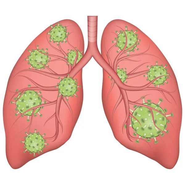 Ilustrație medicală vectorială a plămânilor umani realiști afectați de coronavirus. Conceptul de boală pulmonară . — Vector de stoc