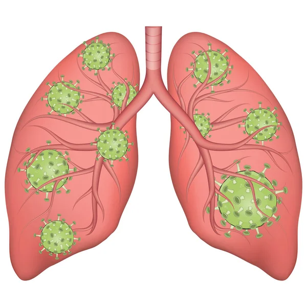 Medizinische Vektor-Illustration realistischer menschlicher Lungen, die vom Coronavirus betroffen sind. Lungenkrankheitskonzept. lizenzfreie Stockillustrationen