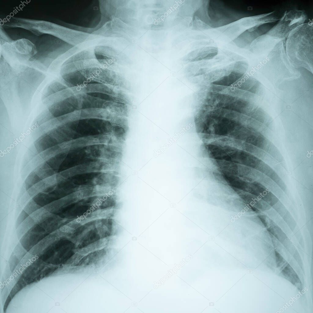 X-Ray radiation image of Chest report. medical diagnosis, Health and healthcare concept