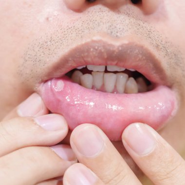 Mouth Ülser Ağrısı veya Afet Mide iltihabı. Oral Sağlık ve Sağlık Konseptleri