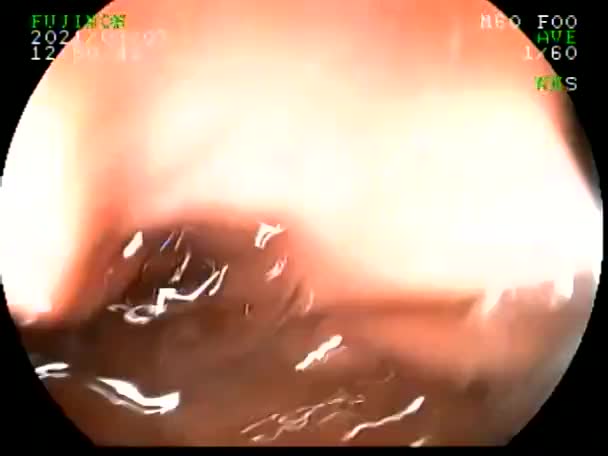 Provádění Gastroskopie Biopsií Pacienta Bolestí Břicha Fotografování Gastrointestinálního Traktu Pacienta — Stock video
