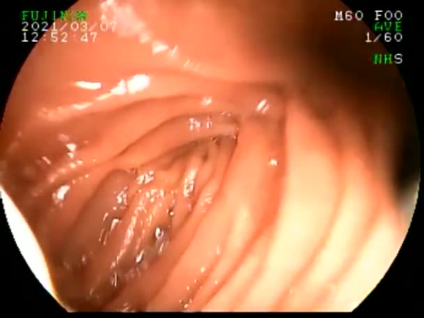 Realizar Gastroscopia Con Biopsia Paciente Con Dolor Abdominal Fotografiando Tracto — Vídeo de stock