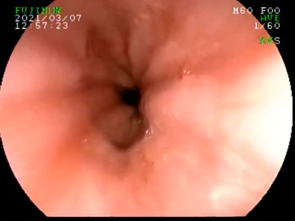 Realização Gastroscopia Com Biópsia Paciente Com Dor Abdominal Fotografando Trato — Vídeo de Stock