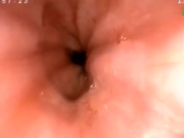 Karın ağrısı olan hastaya biyopsi yaparak gastroskopi yapmak bir hastanın gastrointestinal bölgesini fotoğraflamak.