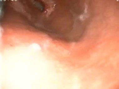 Karın ağrısı olan hastaya biyopsi yaparak gastroskopi yapmak bir hastanın gastrointestinal bölgesini fotoğraflamak.