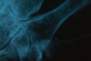 Osteoporoz ve eklem iltihabı artrosit, kemik hasarı, teşhis ve tedavi olan yaşlı bir kişinin röntgeni.