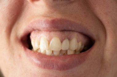 Genç bir kızın çarpık sarı dişleri, yakın plan, büyüyen dişleri, örneğin dişleri, ağzı, baklavaları.