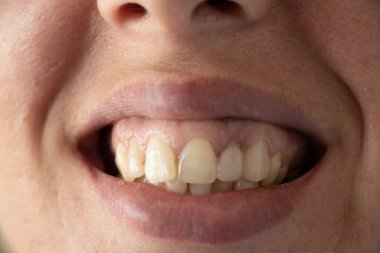 Genç bir kızın çarpık sarı dişleri, yakın plan, büyüyen dişleri, örneğin dişleri, ağzı, baklavaları.