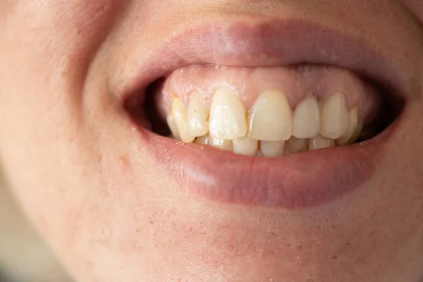 crooked yellow teeth of a young girl close-up, open growing with bad teeth for example, teeth and mouth, caries