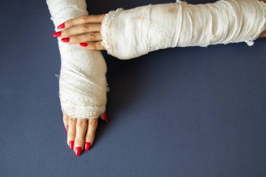 İzole bir arka planda alçıda bisikletten düştükten sonra bilekleri kırık iki kadın eli, alçıda eller.