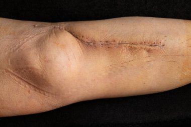 Bir kadının incik kemiğinde, açık redüksiyon ve kaval kemiğinde metal bir plaka kırığının ardından taze bir ameliyat sonrası yara izi görülüyor.