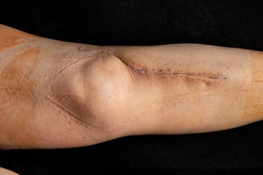 Bir kadının incik kemiğinde, açık redüksiyon ve kaval kemiğinde metal bir plaka kırığının ardından taze bir ameliyat sonrası yara izi görülüyor.