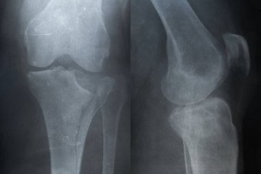 Sandalyeden düştükten sonra kaval kemiği kırılmış bir kadının bacağının röntgeni, yaralanma çizgilerini ve kemik yapısını gösteriyor.