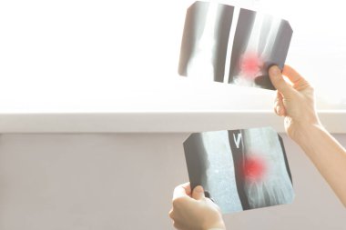 Bir doktor kırık bir kolun röntgenlerini açık ekran üzerinde tutuyor ve inceliyor. Tıbbi yaralanma, kemik izleme ve tedavi teşhisi