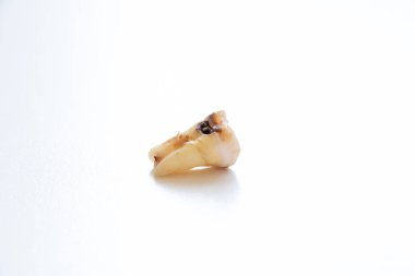 A removed wisdom tooth with decay lies on a white surface for the topics of dentistry, tooth extraction, caries treatment, complications, and prevention of dental diseases