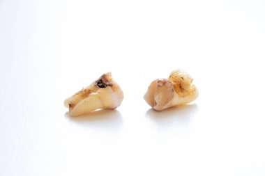 Çürümüş yirmilik dişleri beyaz bir yüzeyde diş hekimliği, diş çekilmesi, karaciğer tedavisi, komplikasyonlar ve diş hastalıklarının önlenmesi konularında yatar.