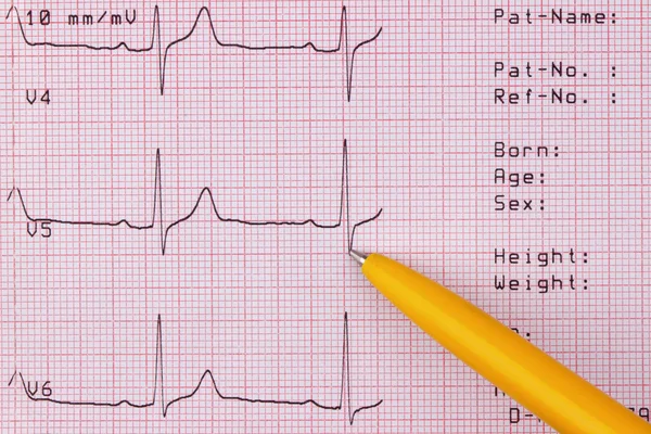 Cardiogram of heart beat — Stock Photo, Image