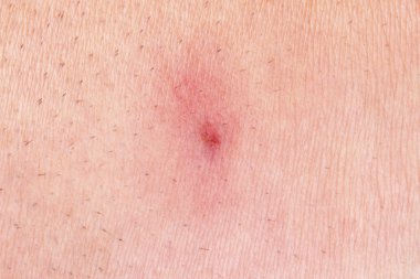 Human skin infection