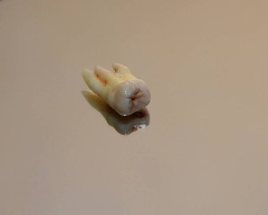             Yirmilik diş masada.