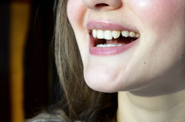 Falta de incisivos laterais. Dentes antes da colocação — Fotografia de Stock