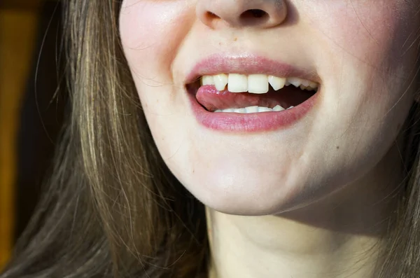 Brist på sidoframtänder. Tänder före placering — Stockfoto