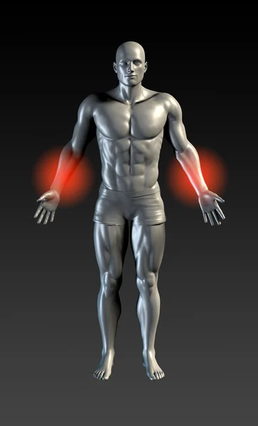 Forearm Injury Concept — Stock Photo, Image