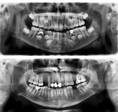 Panoramic dental x-ray tooth's of young man of 30 thirty and child of 7 seven years clipart