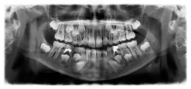 Panoramic dental x-ray of child of seven 7 years clipart