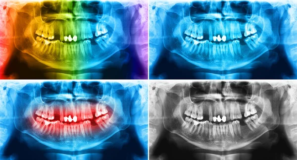 X-ray teeth mandible human skull — Stock fotografie