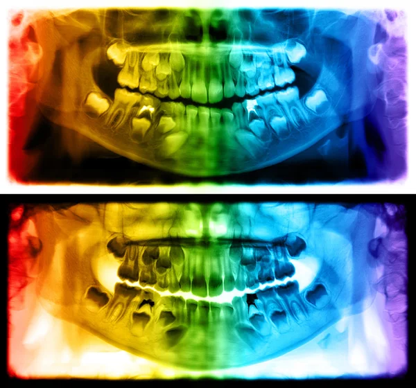 Radiografia dentale panoramica del bambino di sette anni — Foto Stock