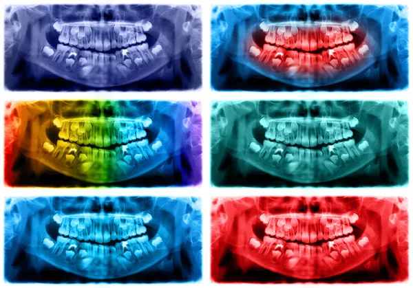 Gekleurde panoramische tandheelkundige x-ray van kind van zeven 7 jaar — Stockfoto