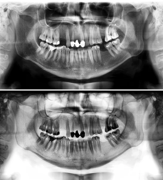 Панорамне рентгенівське випромінювання молодої людини — стокове фото