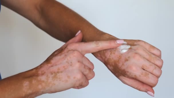 Un primer plano de una mujer irreconocible con manchas de vitiligo aplicando una crema terapéutica en la piel de sus manos. Diversidad Cuerpo concepto de aceptación positiva. — Vídeo de stock