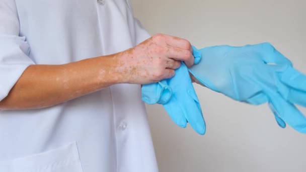 Close-up dari tangan wanita dengan bintik-bintik vitiligo. Seorang dokter bermantel putih memakai sarung tangan karet biru. Konsep Diversity Body positive Acceptance. — Stok Video