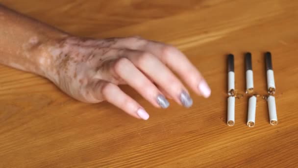 Close Mão Uma Mulher Com Doença Vitiligo Perto Cigarros Quebrados — Vídeo de Stock