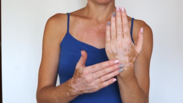 A close-up shot of an unrecognizable woman with vitiligo spots applying a therapeutic cream on the skin of her hands. Diversity Body positive Acceptance concept. — Stock Video