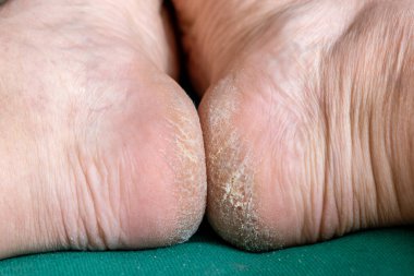 Üzerinde beyaz lekeler olan bir insanın ayaklarının yakın çekimi.