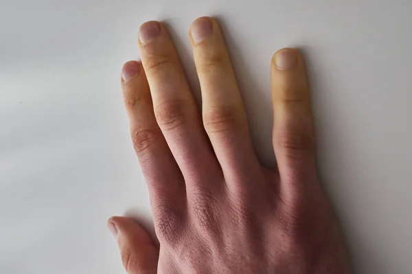 White Fingers Cold Poor Blood Circulation — Stock Photo, Image